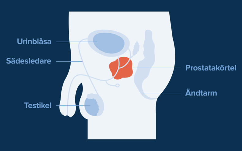 Prostatacancer 1.jpg